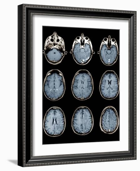 Normal Brain, MRI Scans-ZEPHYR-Framed Photographic Print