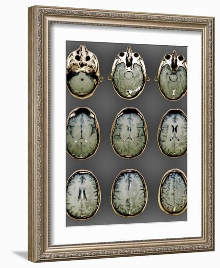 Normal Brain, MRI Scans-ZEPHYR-Framed Photographic Print