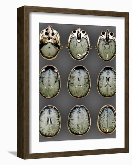 Normal Brain, MRI Scans-ZEPHYR-Framed Photographic Print