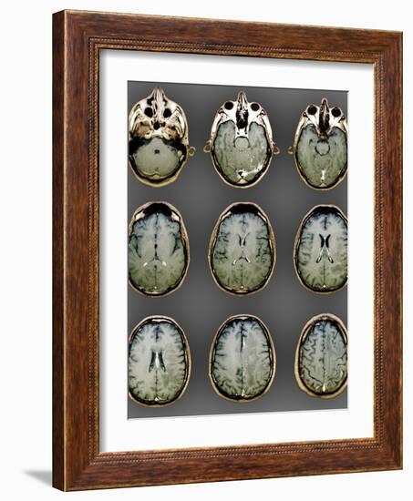 Normal Brain, MRI Scans-ZEPHYR-Framed Photographic Print