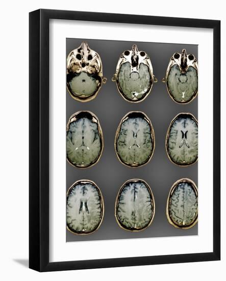 Normal Brain, MRI Scans-ZEPHYR-Framed Photographic Print