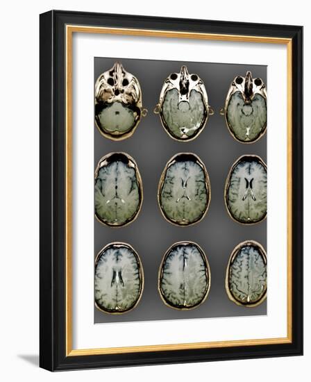 Normal Brain, MRI Scans-ZEPHYR-Framed Photographic Print