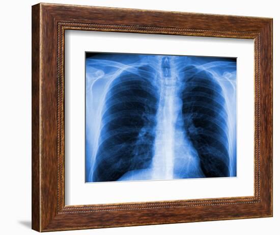 Normal Chest X-ray-PASIEKA-Framed Photographic Print