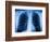 Normal Chest X-ray-PASIEKA-Framed Photographic Print