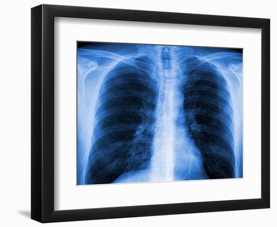 Normal Chest X-ray-PASIEKA-Framed Photographic Print