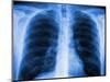 Normal Chest X-ray-PASIEKA-Mounted Photographic Print