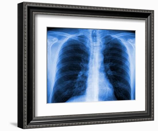 Normal Chest X-ray-PASIEKA-Framed Photographic Print