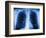 Normal Chest X-ray-PASIEKA-Framed Photographic Print