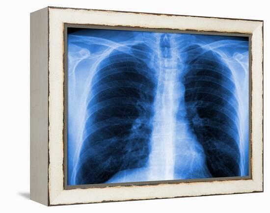 Normal Chest X-ray-PASIEKA-Framed Premier Image Canvas