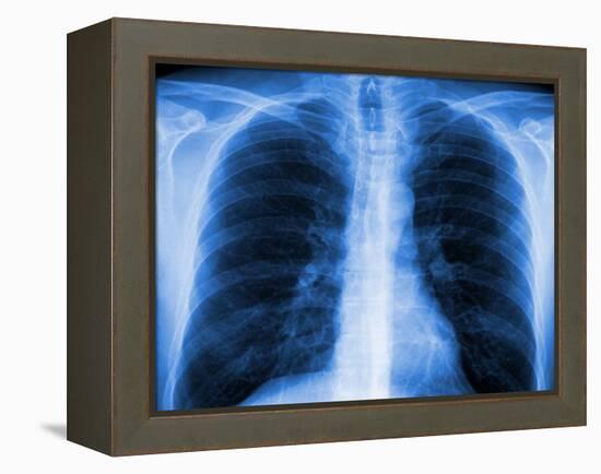 Normal Chest X-ray-PASIEKA-Framed Premier Image Canvas