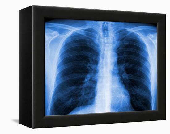 Normal Chest X-ray-PASIEKA-Framed Premier Image Canvas