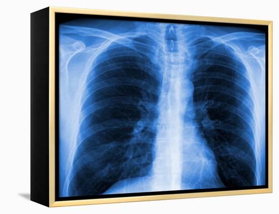 Normal Chest X-ray-PASIEKA-Framed Premier Image Canvas