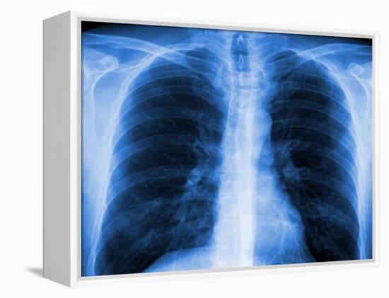 Normal Chest X-ray-PASIEKA-Framed Premier Image Canvas