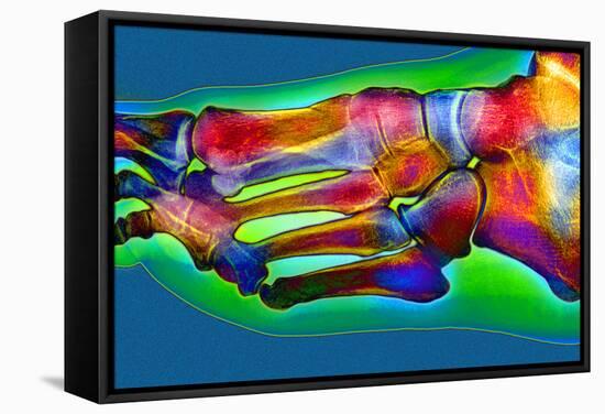 Normal Foot, X-ray-Du Cane Medical-Framed Premier Image Canvas