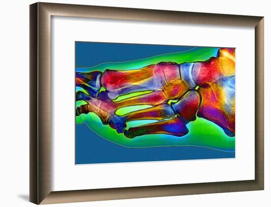 Normal Foot, X-ray-Du Cane Medical-Framed Photographic Print