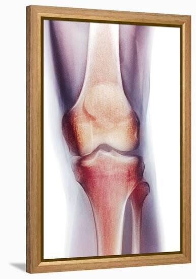 Normal Knee, X-ray-Du Cane Medical-Framed Premier Image Canvas