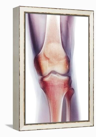 Normal Knee, X-ray-Du Cane Medical-Framed Premier Image Canvas