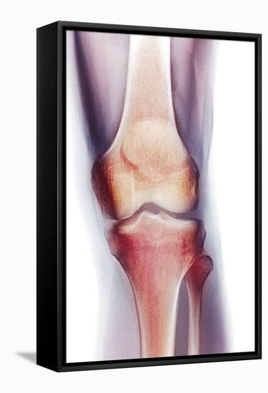 Normal Knee, X-ray-Du Cane Medical-Framed Premier Image Canvas