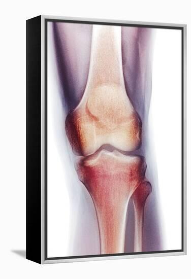 Normal Knee, X-ray-Du Cane Medical-Framed Premier Image Canvas