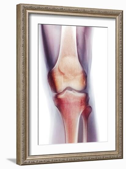 Normal Knee, X-ray-Du Cane Medical-Framed Photographic Print