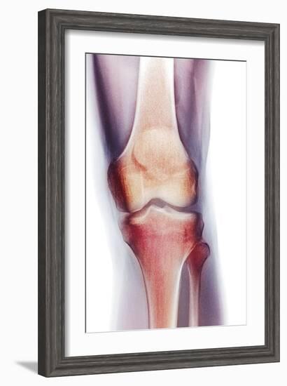 Normal Knee, X-ray-Du Cane Medical-Framed Photographic Print