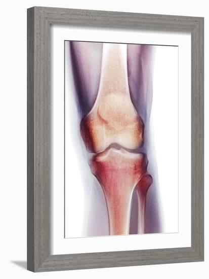 Normal Knee, X-ray-Du Cane Medical-Framed Photographic Print