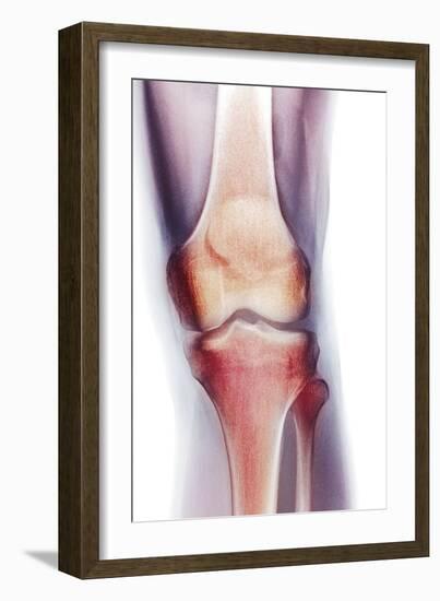 Normal Knee, X-ray-Du Cane Medical-Framed Photographic Print