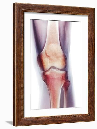 Normal Knee, X-ray-Du Cane Medical-Framed Photographic Print