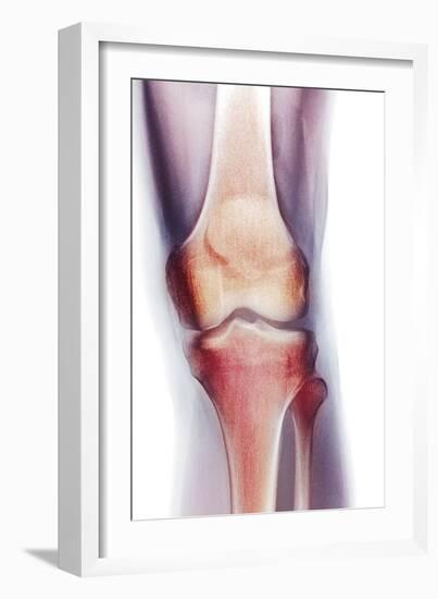 Normal Knee, X-ray-Du Cane Medical-Framed Photographic Print