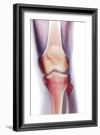 Normal Knee, X-ray-Du Cane Medical-Framed Photographic Print