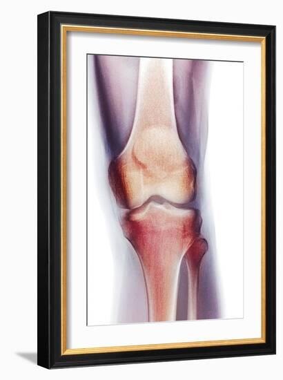 Normal Knee, X-ray-Du Cane Medical-Framed Photographic Print