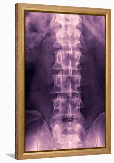 Normal Lumbar Spine, X-ray-Miriam Maslo-Framed Premier Image Canvas