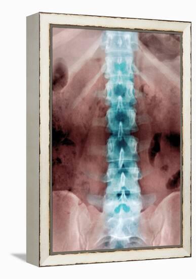 Normal Lumbar Spine, X-ray-Du Cane Medical-Framed Premier Image Canvas