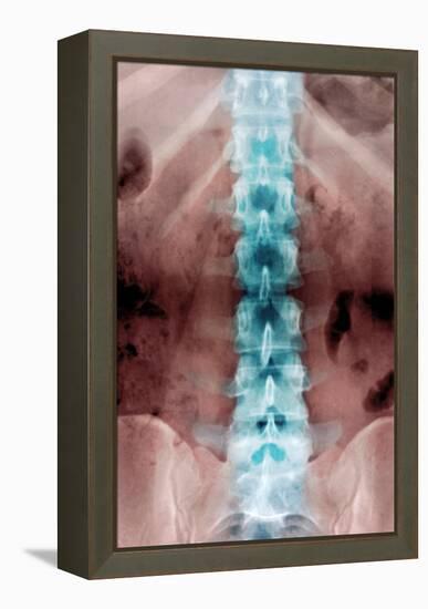 Normal Lumbar Spine, X-ray-Du Cane Medical-Framed Premier Image Canvas