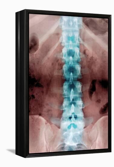 Normal Lumbar Spine, X-ray-Du Cane Medical-Framed Premier Image Canvas