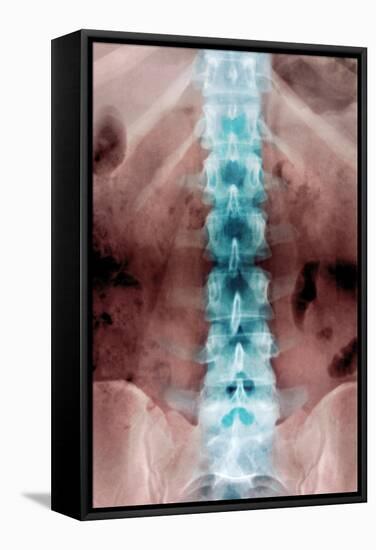 Normal Lumbar Spine, X-ray-Du Cane Medical-Framed Premier Image Canvas