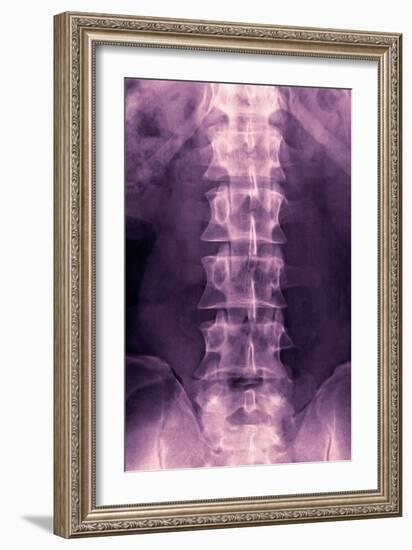 Normal Lumbar Spine, X-ray-Miriam Maslo-Framed Photographic Print