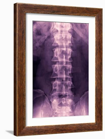 Normal Lumbar Spine, X-ray-Miriam Maslo-Framed Photographic Print