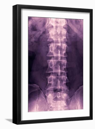 Normal Lumbar Spine, X-ray-Miriam Maslo-Framed Photographic Print