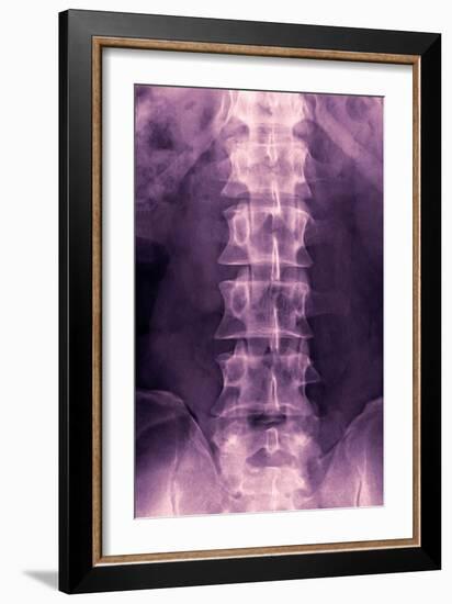 Normal Lumbar Spine, X-ray-Miriam Maslo-Framed Photographic Print