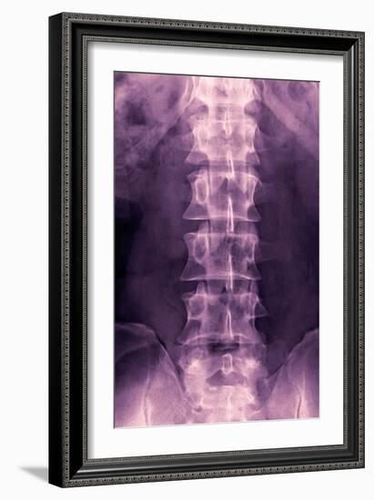 Normal Lumbar Spine, X-ray-Miriam Maslo-Framed Photographic Print