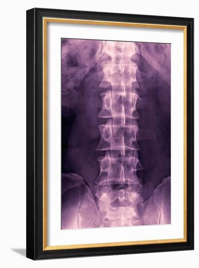 Normal Lumbar Spine, X-ray-Miriam Maslo-Framed Photographic Print