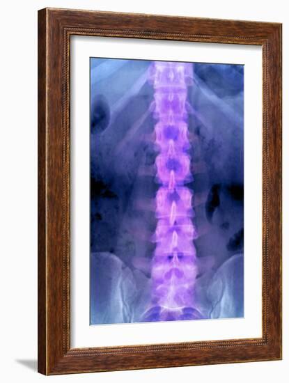 Normal Lumbar Spine, X-ray-Du Cane Medical-Framed Photographic Print