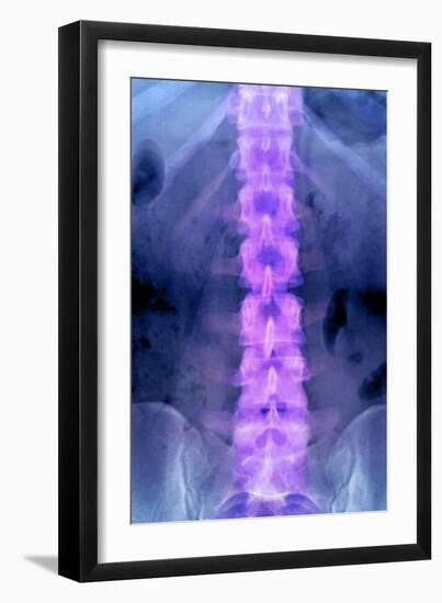 Normal Lumbar Spine, X-ray-Du Cane Medical-Framed Photographic Print