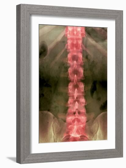 Normal Lumbar Spine, X-ray-Du Cane Medical-Framed Photographic Print