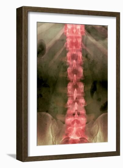 Normal Lumbar Spine, X-ray-Du Cane Medical-Framed Photographic Print