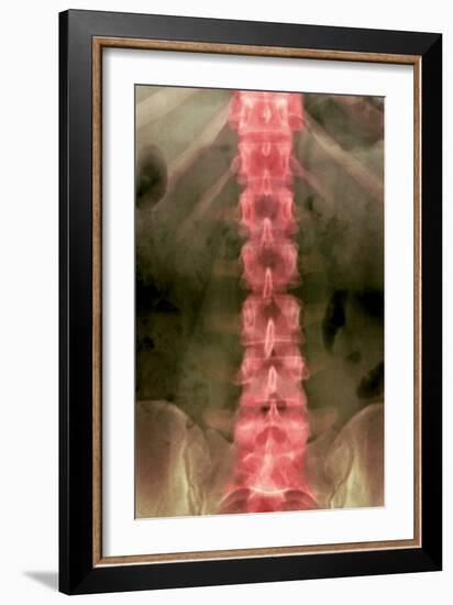 Normal Lumbar Spine, X-ray-Du Cane Medical-Framed Photographic Print