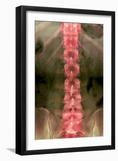 Normal Lumbar Spine, X-ray-Du Cane Medical-Framed Photographic Print