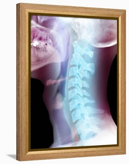 Normal Neck, X-ray-Du Cane Medical-Framed Premier Image Canvas