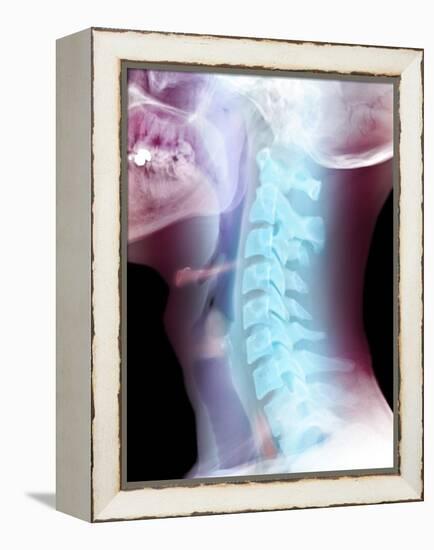 Normal Neck, X-ray-Du Cane Medical-Framed Premier Image Canvas